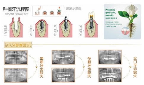 最新种植牙技术，重塑笑容的信赖之选